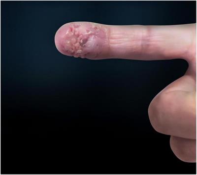 Case Report: An Ulceration With a Stalactite Appearance on the Index Finger